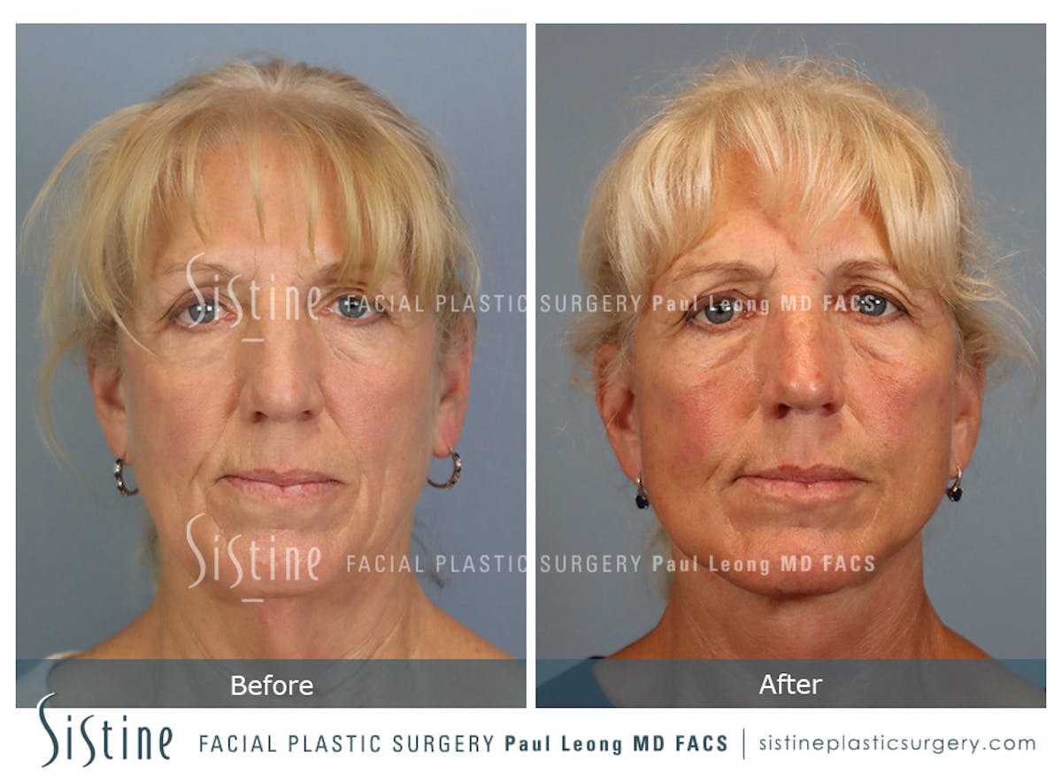 Facelift Before & After Gallery - Patient 255906 - Image 1