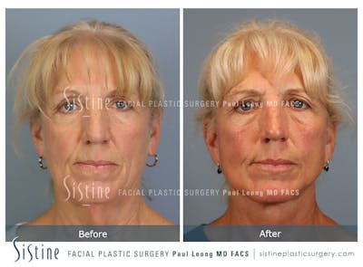 Facelift Before & After Gallery - Patient 255906 - Image 1