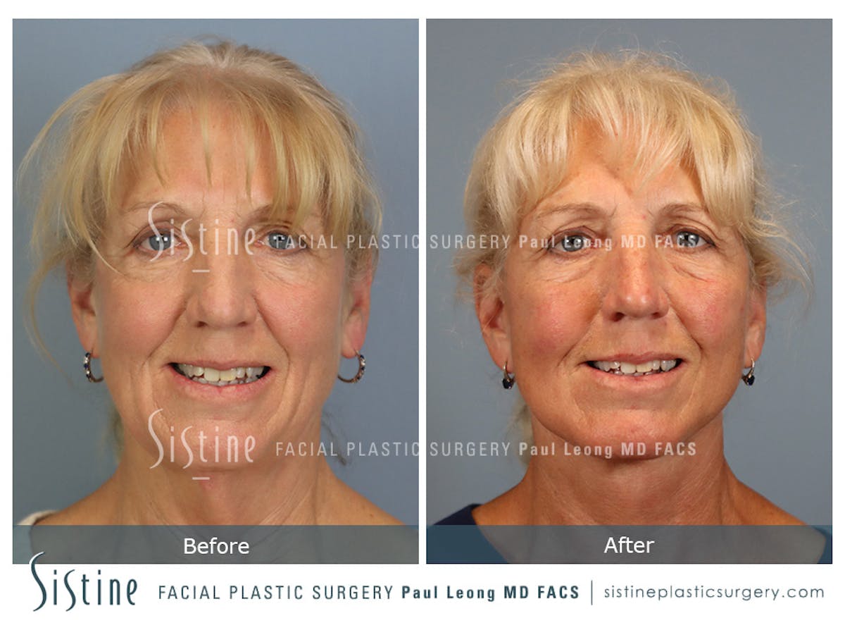Facelift Before & After Gallery - Patient 255906 - Image 2