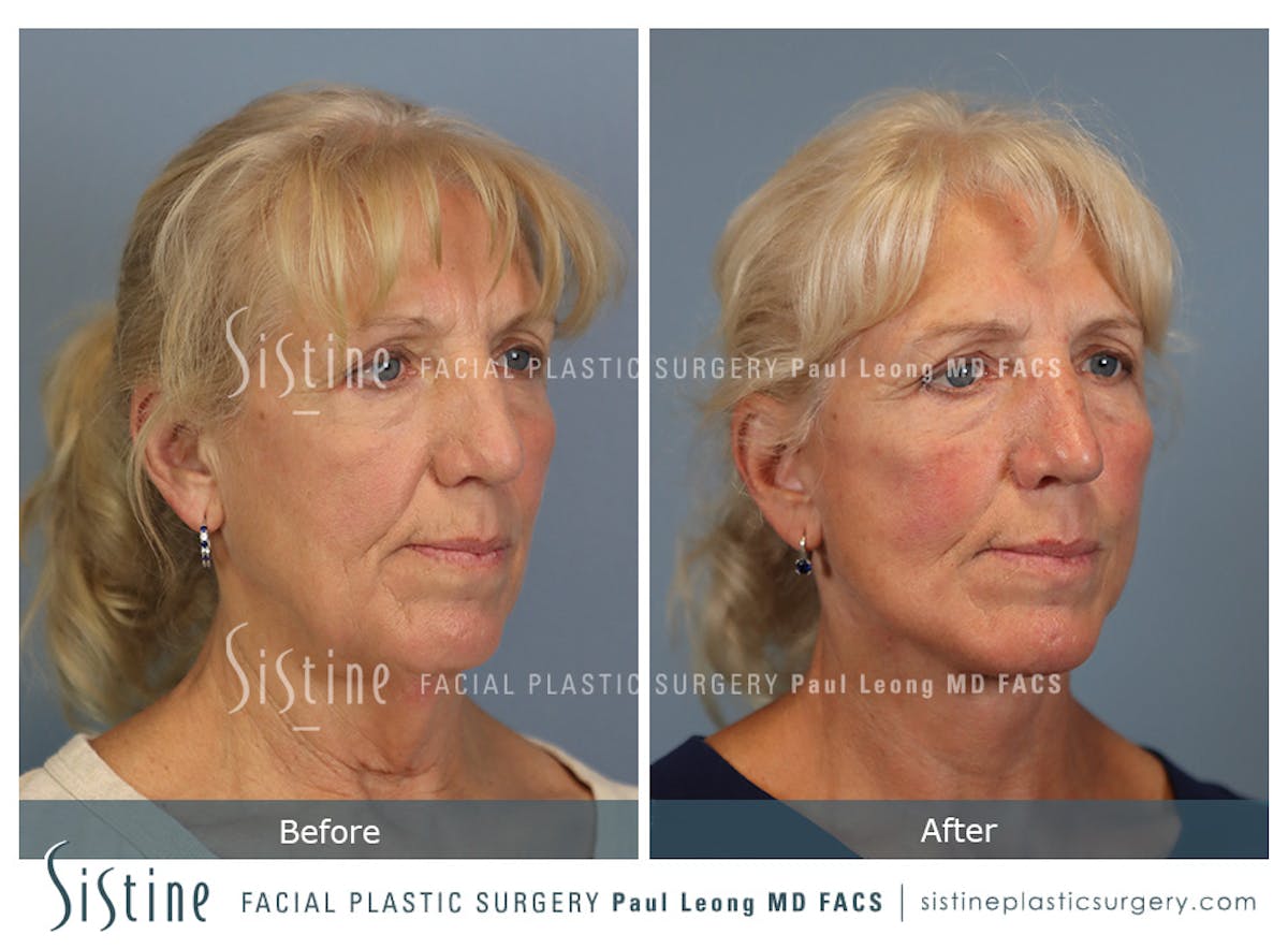 Facelift Before & After Gallery - Patient 255906 - Image 3