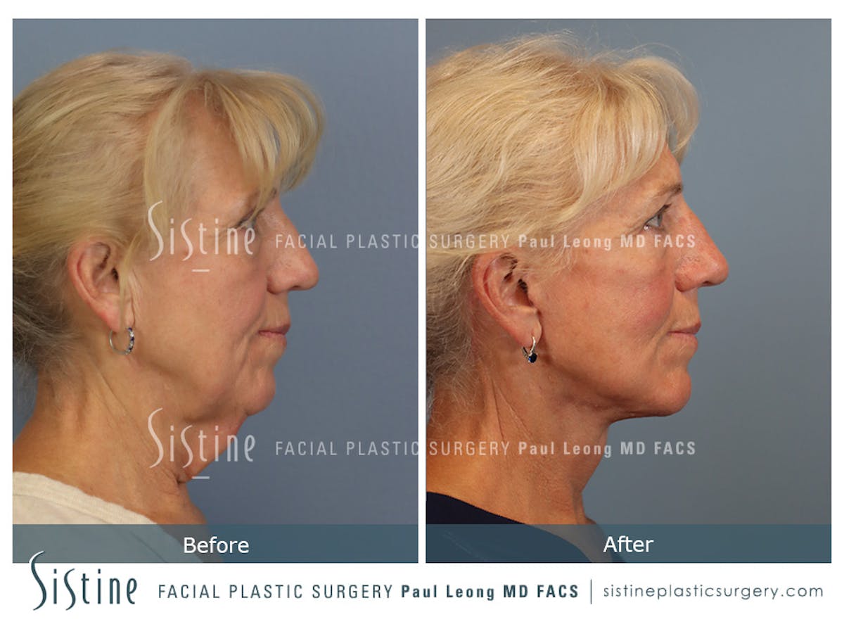 Facelift Before & After Gallery - Patient 255906 - Image 4