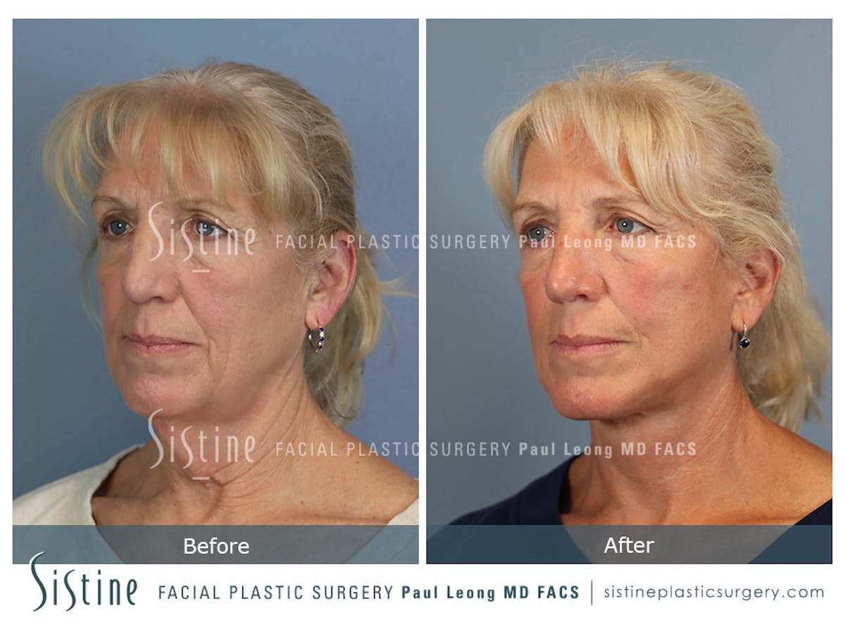 Facelift Before & After Gallery - Patient 255906 - Image 6