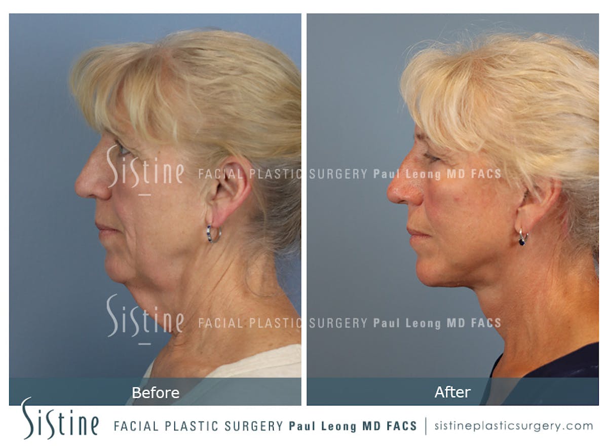 Facelift Before & After Gallery - Patient 255906 - Image 7