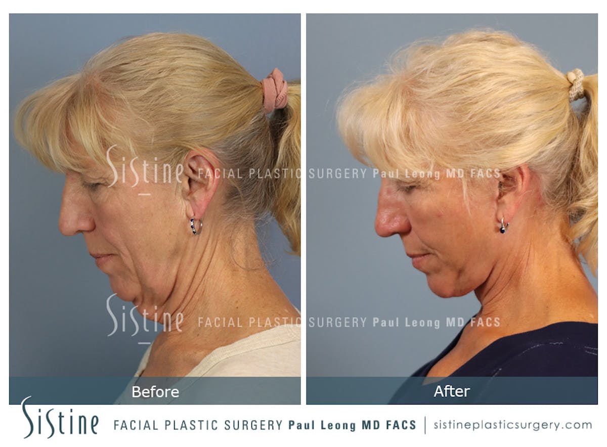 Facelift Before & After Gallery - Patient 255906 - Image 8