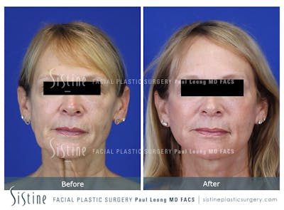 Facelift Before & After Gallery - Patient 301107 - Image 1