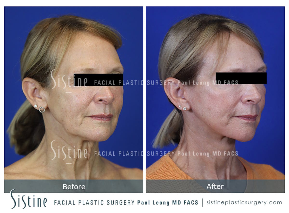 Facelift Before & After Gallery - Patient 301107 - Image 3