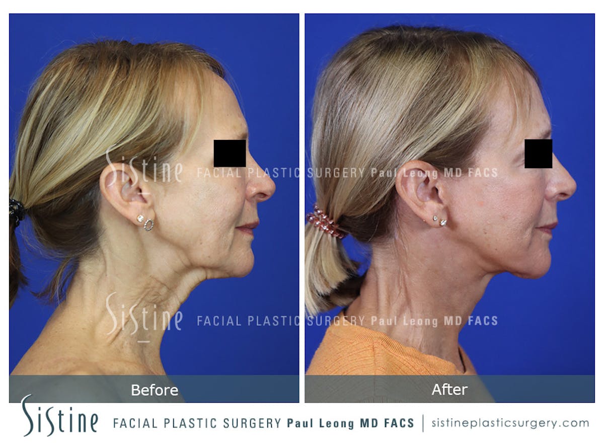 Facelift Before & After Gallery - Patient 301107 - Image 4
