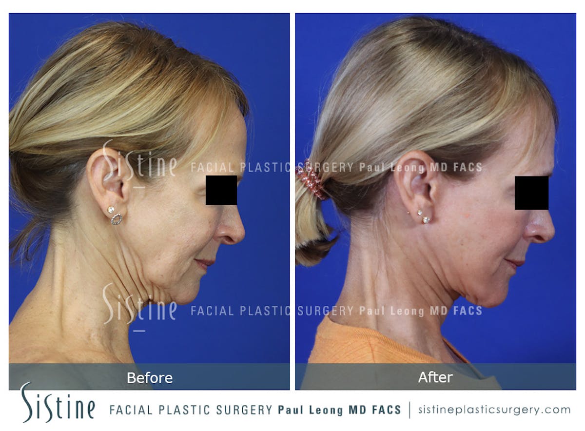 Facelift Before & After Gallery - Patient 301107 - Image 5