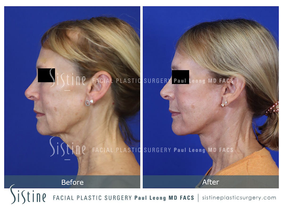 Facelift Before & After Gallery - Patient 301107 - Image 7