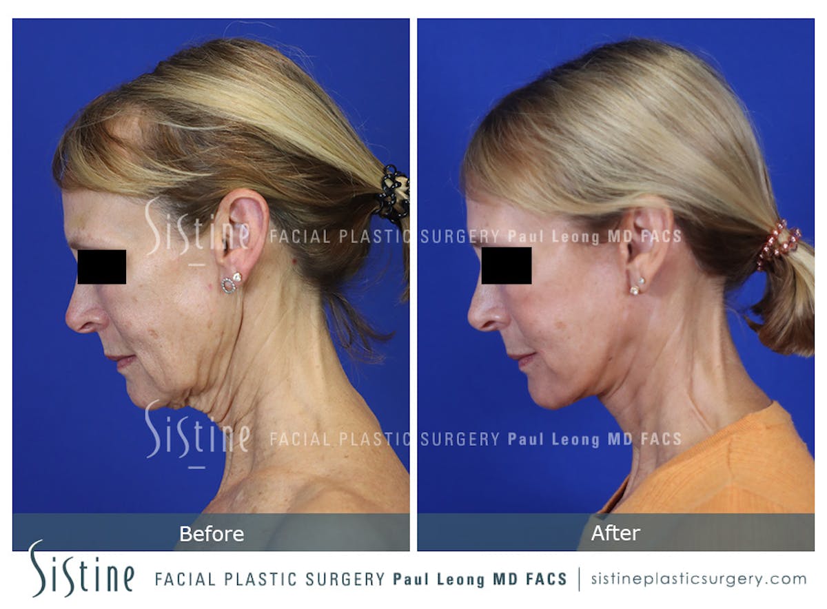 Facelift Before & After Gallery - Patient 301107 - Image 8