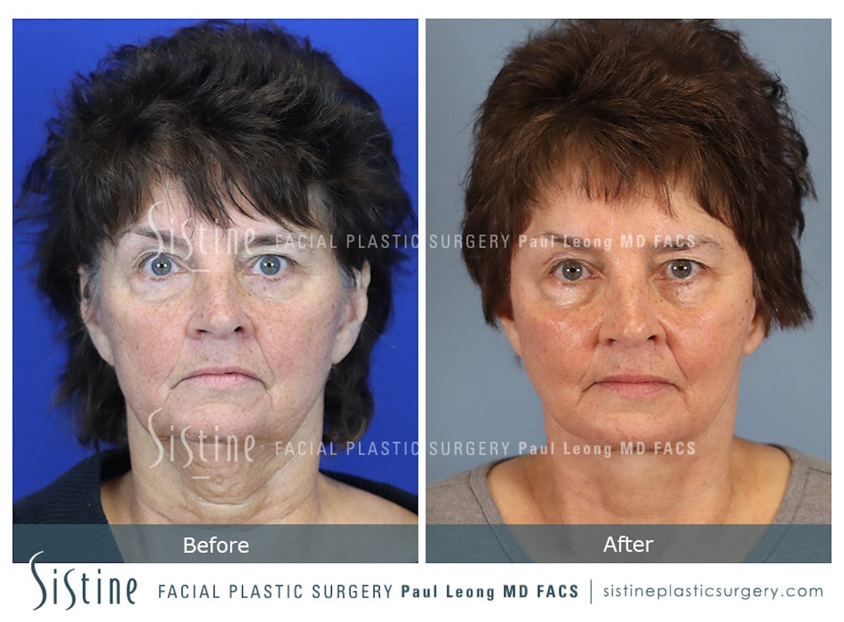 Facelift Before & After Gallery - Patient 231963 - Image 1