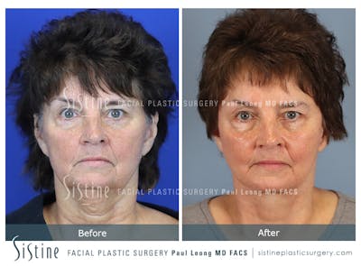 Facelift Before & After Gallery - Patient 231963 - Image 1