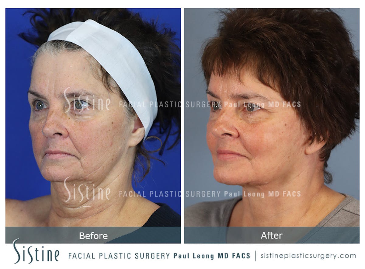 Facelift Before & After Gallery - Patient 231963 - Image 2