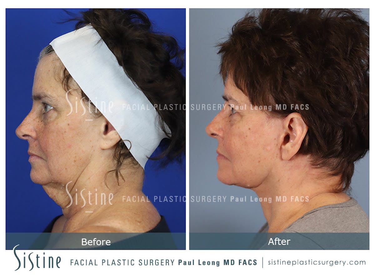 Facelift Before & After Gallery - Patient 231963 - Image 3