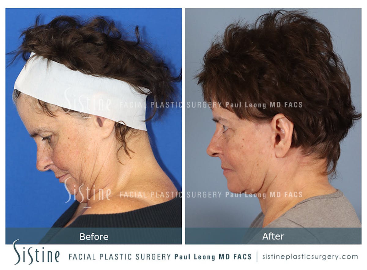 Facelift Before & After Gallery - Patient 231963 - Image 4
