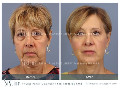 Browlift Before & After Gallery - Patient 266294 - Image 1