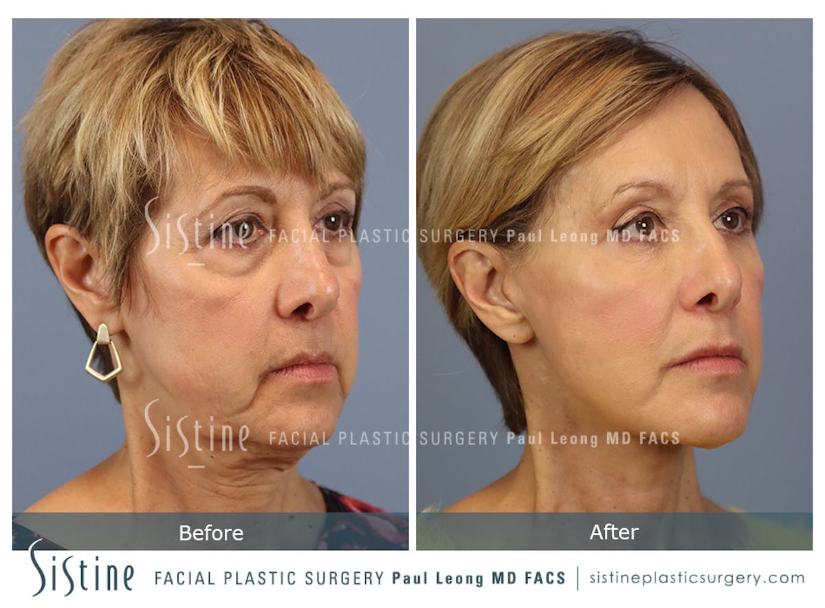 Browlift Before & After Gallery - Patient 266294 - Image 2