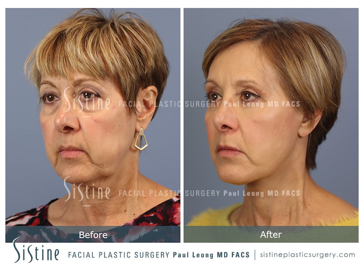 Browlift Before & After Gallery - Patient 266294 - Image 3
