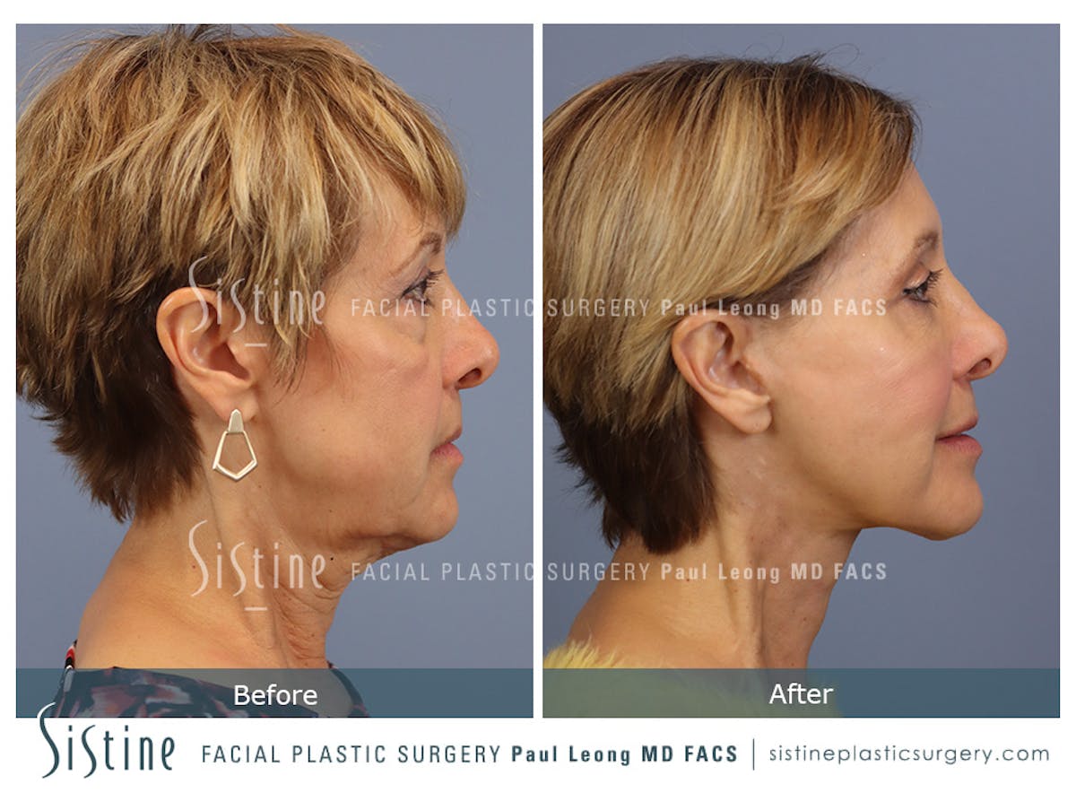 Browlift Before & After Gallery - Patient 266294 - Image 4