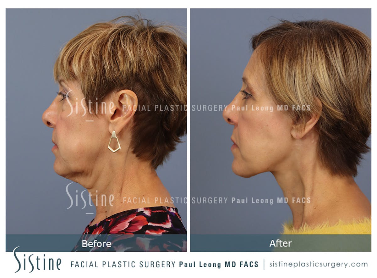 Browlift Before & After Gallery - Patient 266294 - Image 5