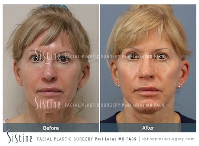 Facelift Before & After Gallery - Patient 254081 - Image 1