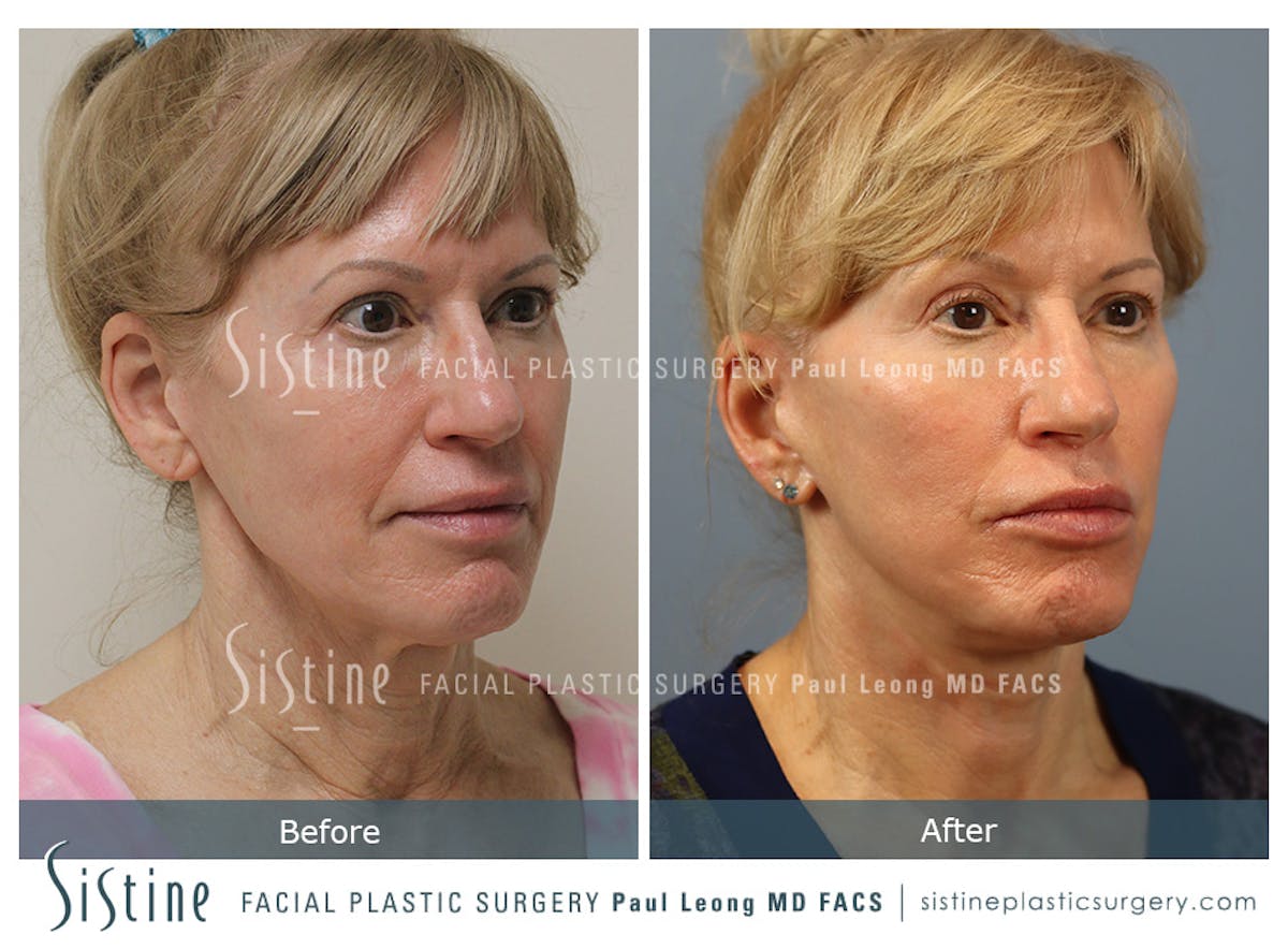 Facelift Before & After Gallery - Patient 254081 - Image 2