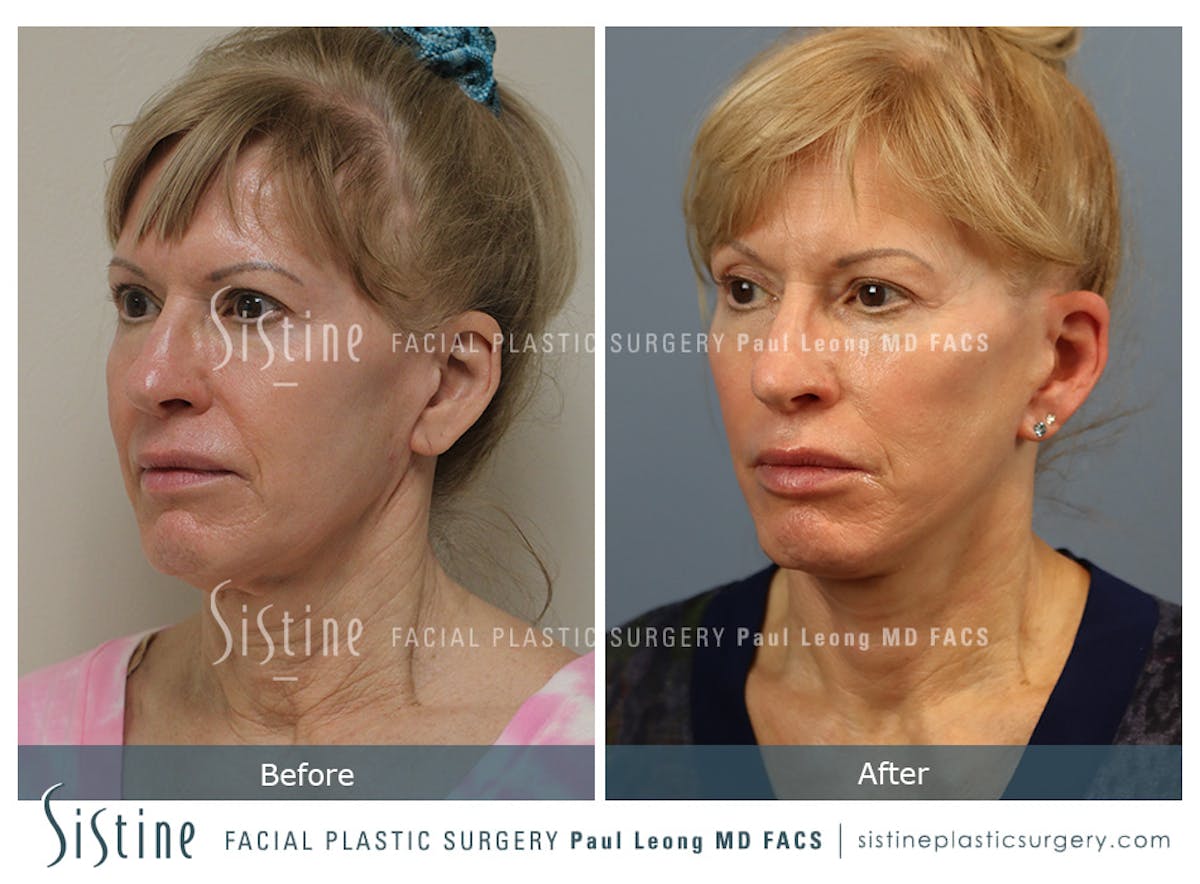 Facelift Before & After Gallery - Patient 254081 - Image 3