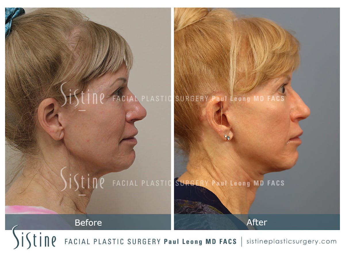 Facelift Before & After Gallery - Patient 254081 - Image 4