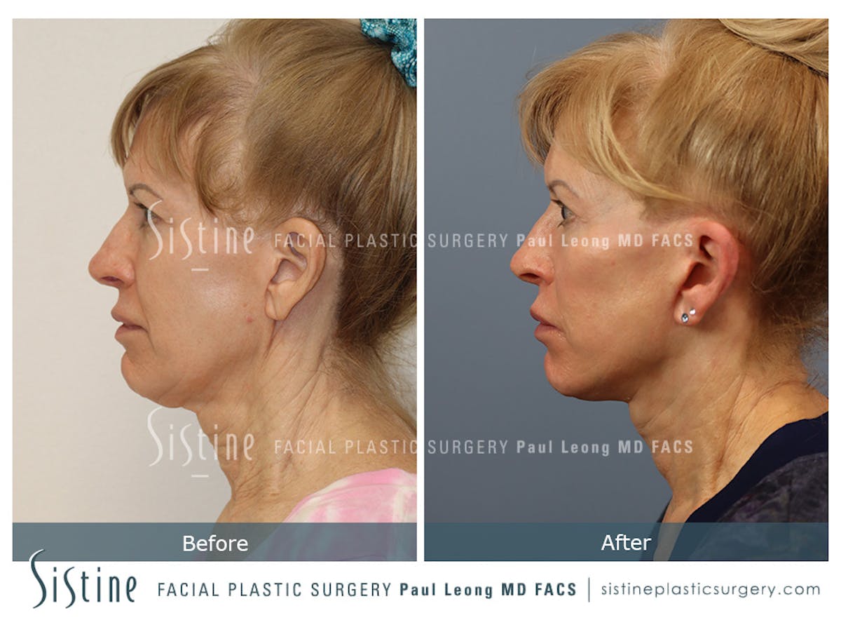 Facelift Before & After Gallery - Patient 254081 - Image 5