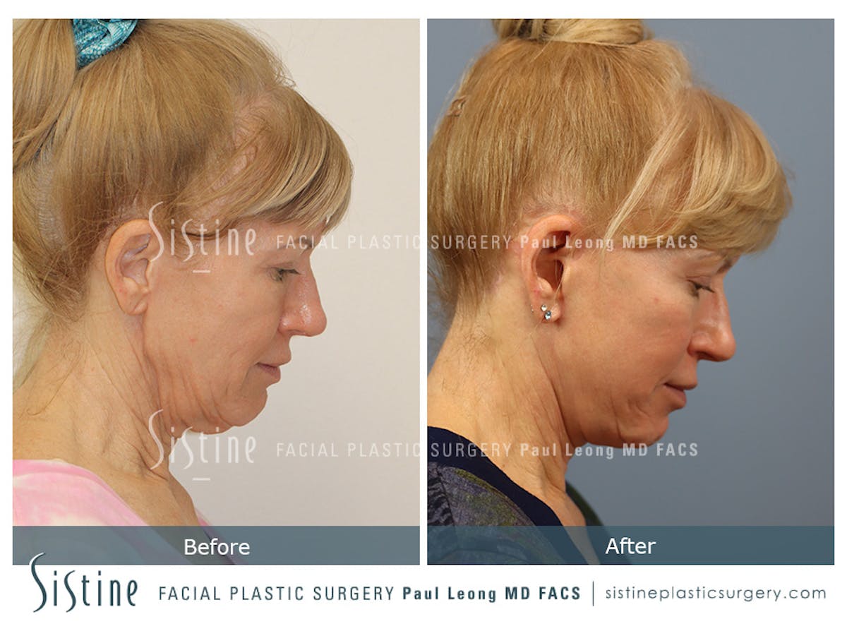 Facelift Before & After Gallery - Patient 254081 - Image 6