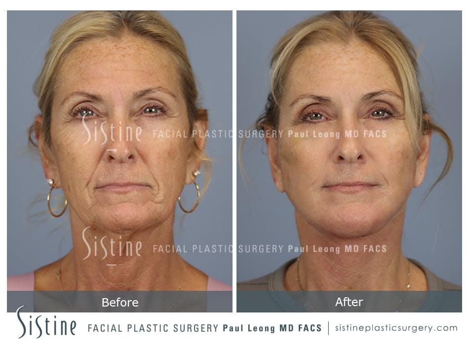 Facelift Before & After Gallery - Patient 279946 - Image 1