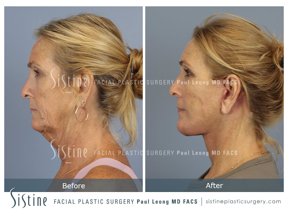 Facelift Before & After Gallery - Patient 279946 - Image 2