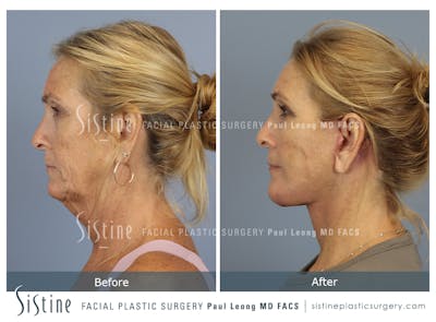 Deep Neck Lift Before & After Gallery - Patient 388347 - Image 1