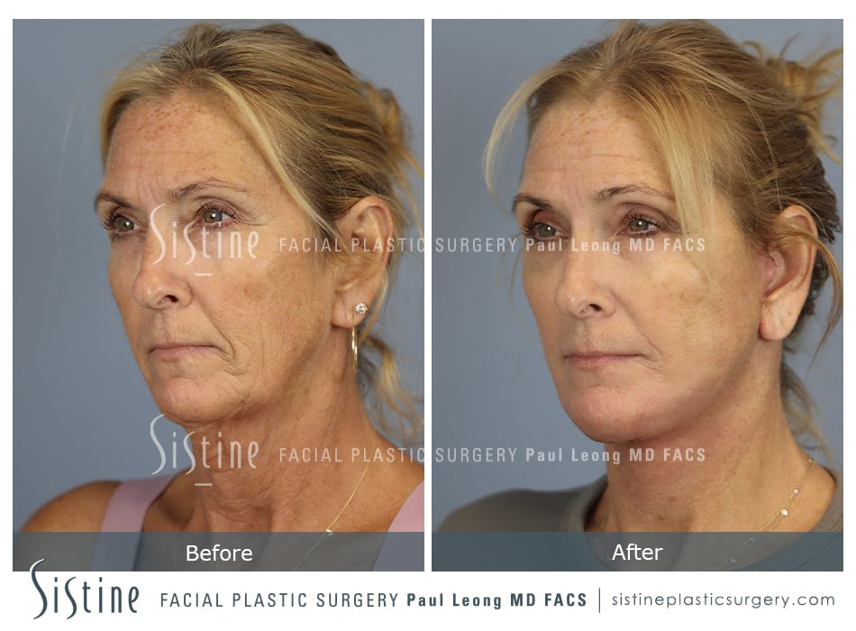 Facelift Before & After Gallery - Patient 279946 - Image 3