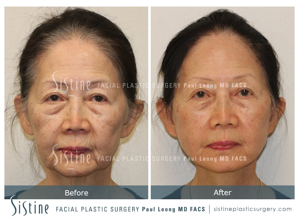 Facelift Before & After Gallery - Patient 309273 - Image 1