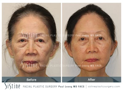 Facelift Before & After Gallery - Patient 309273 - Image 1