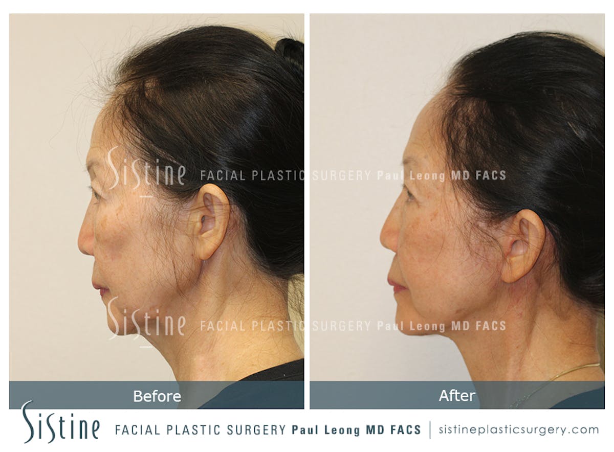 Facelift Before & After Gallery - Patient 309273 - Image 2