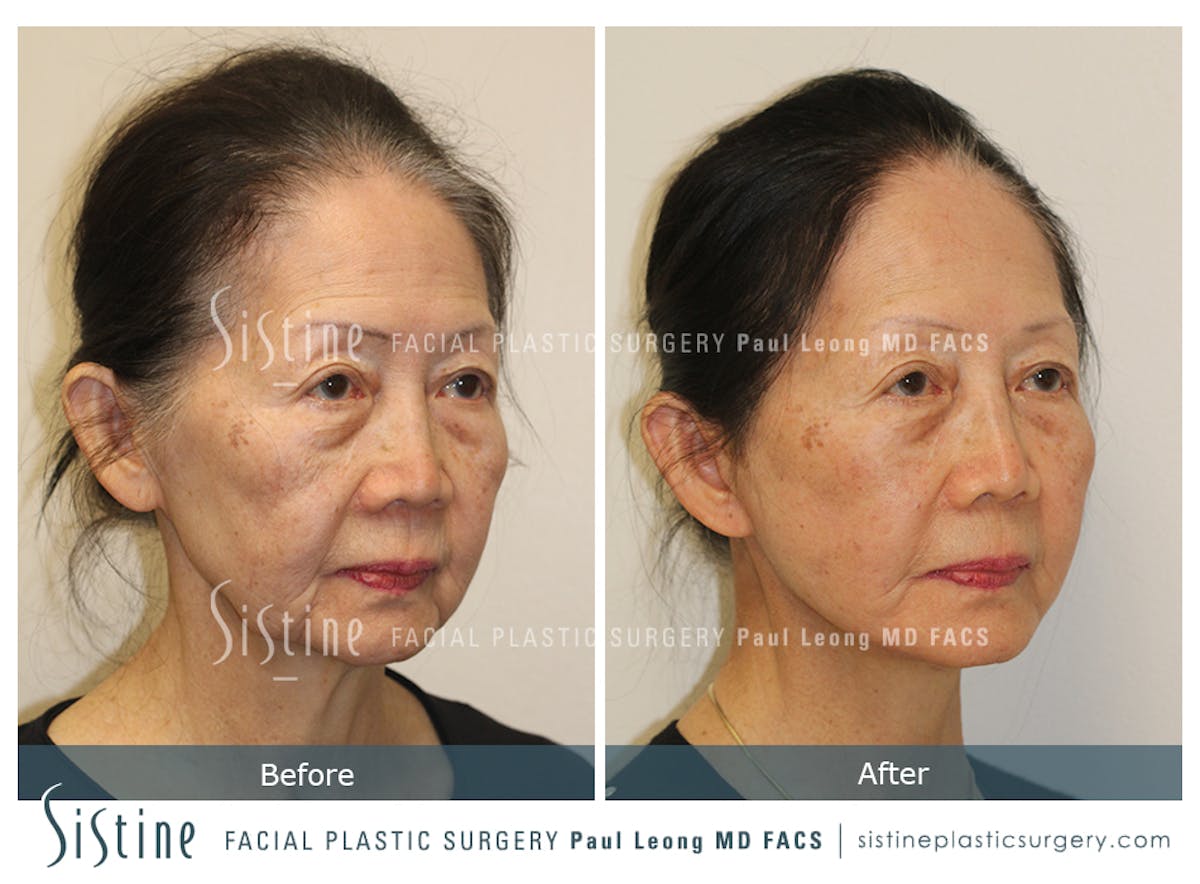 Facelift Before & After Gallery - Patient 309273 - Image 3