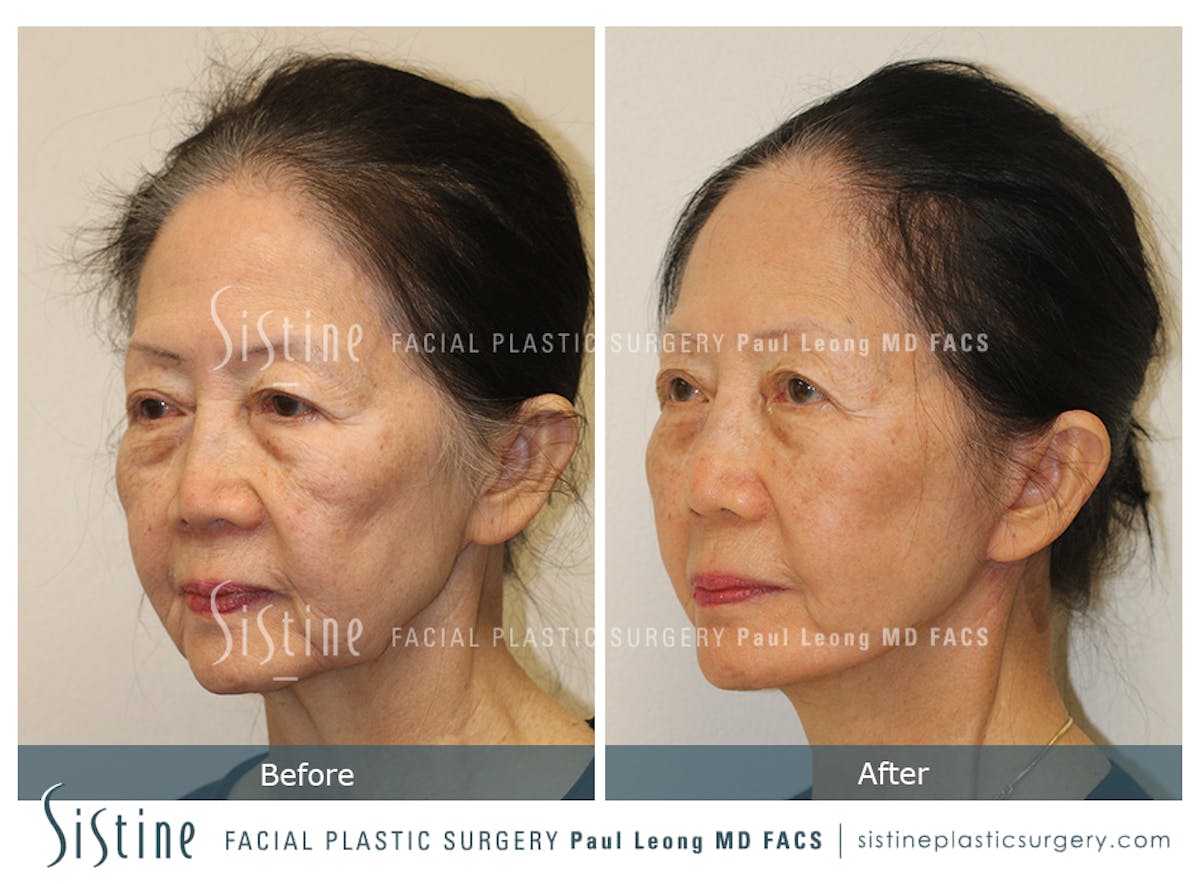 Facelift Before & After Gallery - Patient 309273 - Image 4