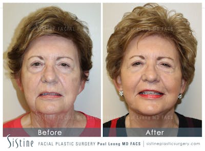 Facelift Before & After Gallery - Patient 955990 - Image 1