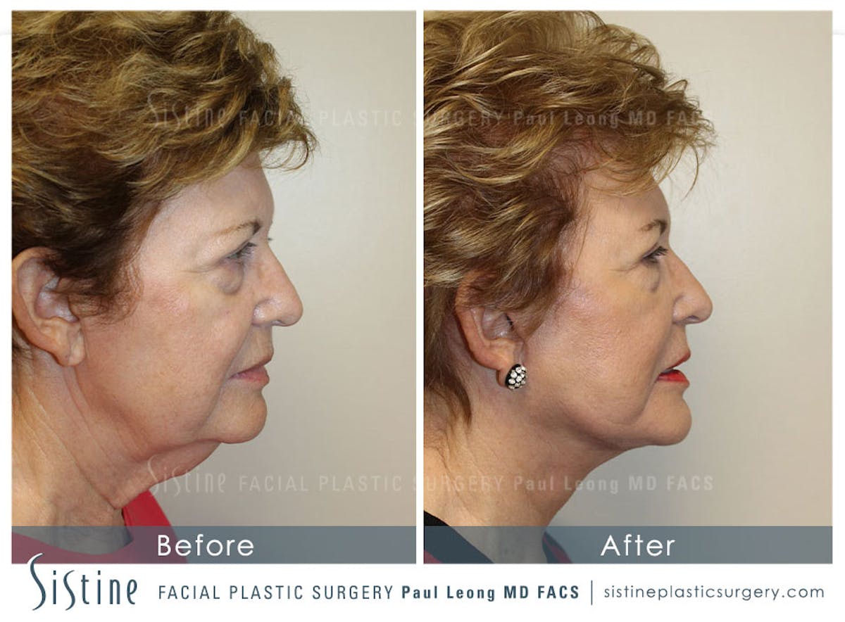 Facelift Before & After Gallery - Patient 955990 - Image 2