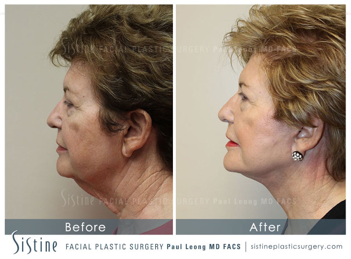 Facelift Before & After Gallery - Patient 955990 - Image 3