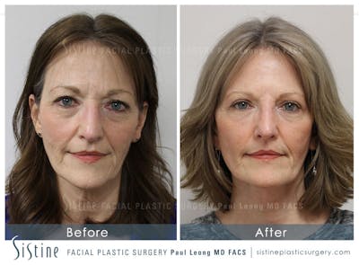 Eyes Before & After Gallery - Patient 377633 - Image 1
