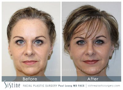 Facelift Before & After Gallery - Patient 642023 - Image 1