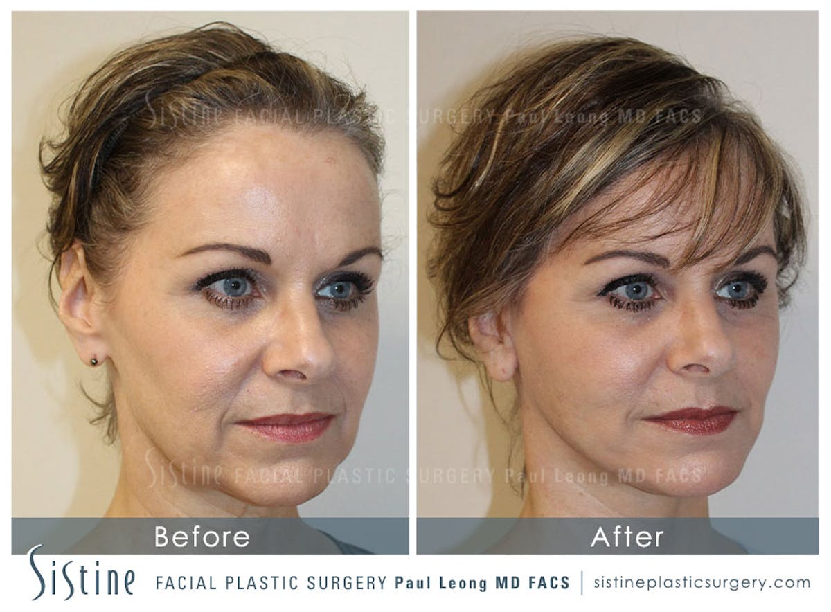 Facelift Before & After Gallery - Patient 642023 - Image 2