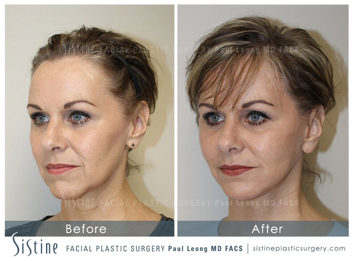 Facelift Before & After Gallery - Patient 642023 - Image 3