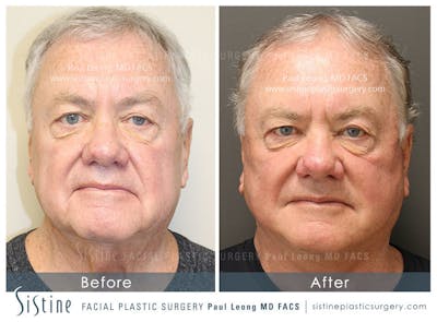 Facelift Before & After Gallery - Patient 407981 - Image 1