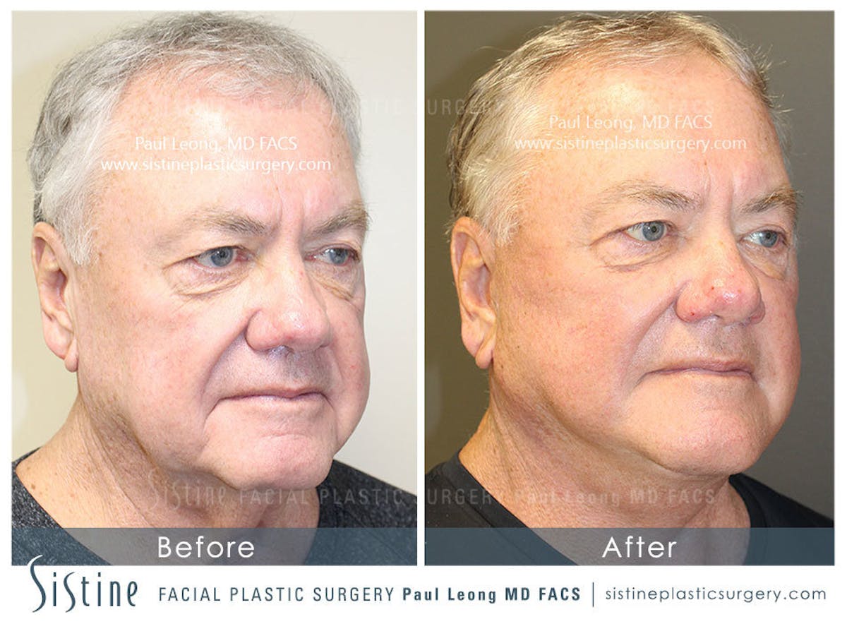 Facelift Before & After Gallery - Patient 407981 - Image 2