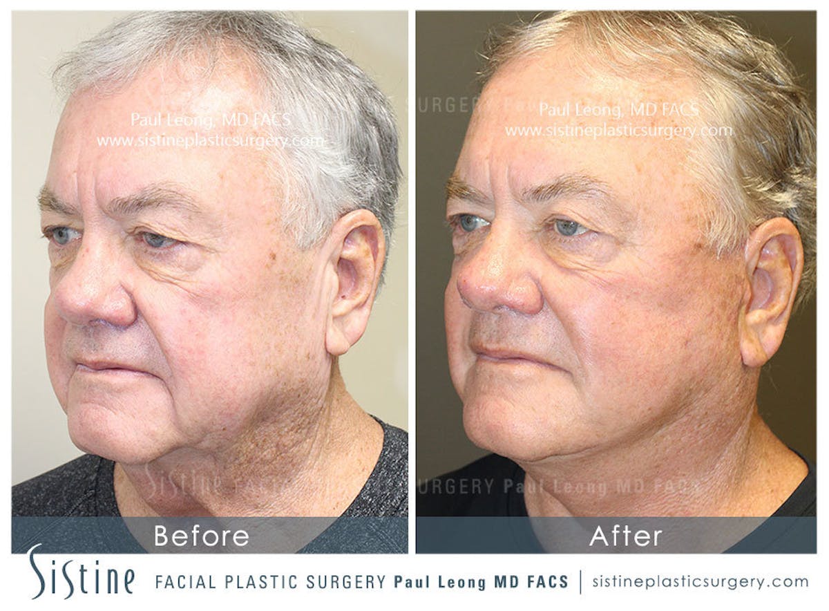 Facelift Before & After Gallery - Patient 407981 - Image 3