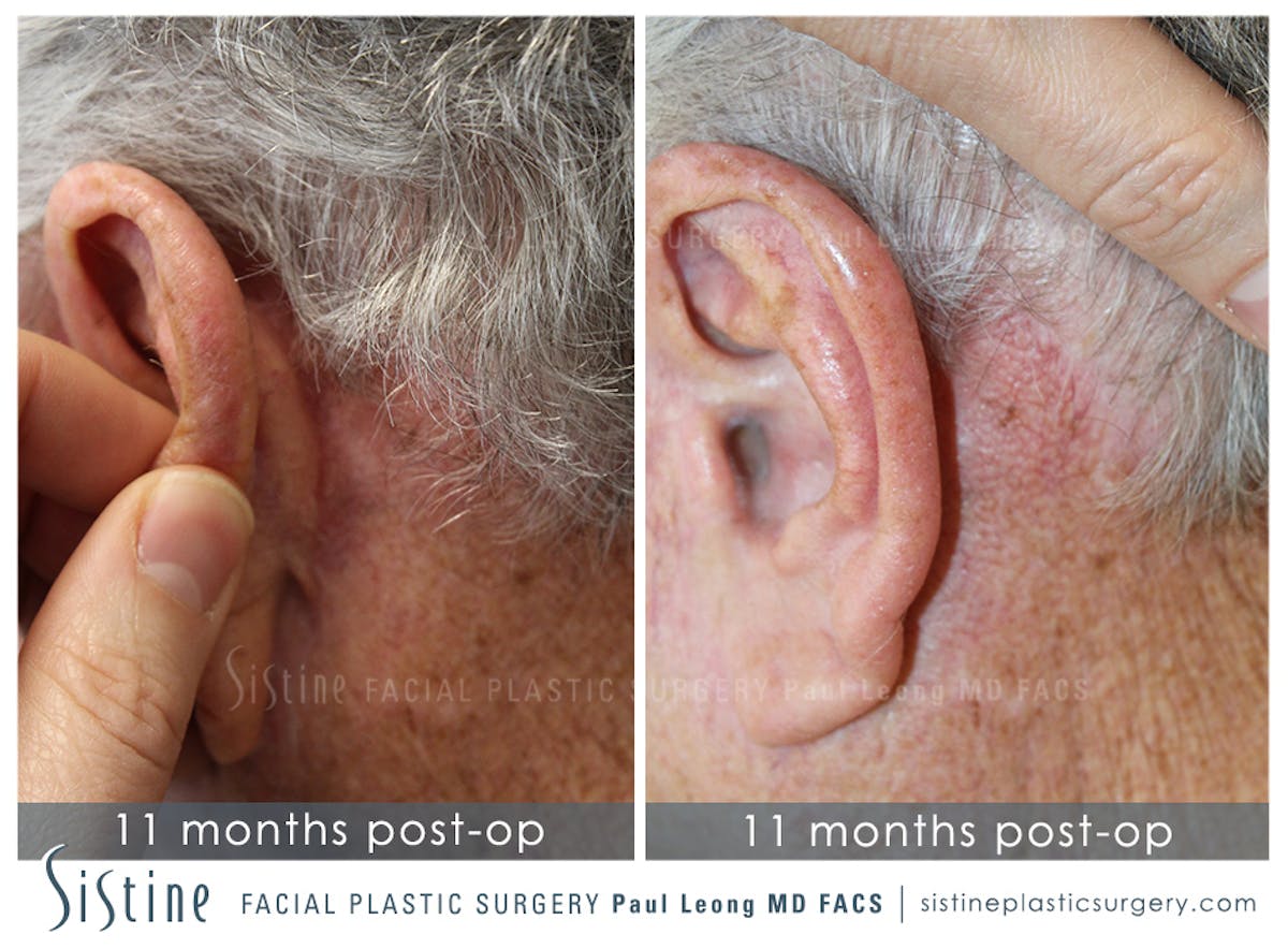Facelift Before & After Gallery - Patient 407981 - Image 4